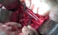 Radikale Chirurgie mit Anatomie Vorlesung - Beckengefäße und Strukturen