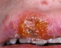 Herpes-simplex-Virus-Infektion auf der Oberlippe - Frühstadium (näherer Blick)