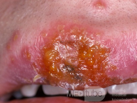 Herpes-simplex-Virus-Infektion auf der Oberlippe - Frühstadium (näherer Blick)