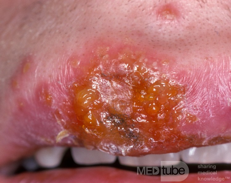 Herpes-simplex-Virus-Infektion auf der Oberlippe - Frühstadium (näherer Blick)