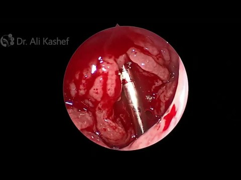 Adenoide por microdebrider
