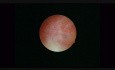 Essure-Sterilisation
