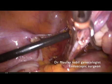 Totale laparoskopische Hysterektomie für Assistenzärzte