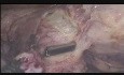 Myome an der anterioren Wand- laparoskopische Myomektomie