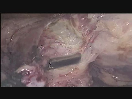Myome an der anterioren Wand- laparoskopische Myomektomie