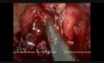 Laparoskopische Appendektomie bei gangränöser Blinddarmentzündung