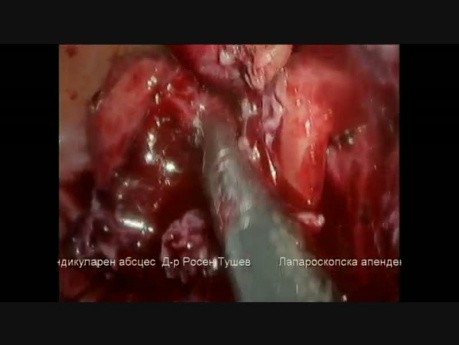 Laparoskopische Appendektomie bei gangränöser Blinddarmentzündung