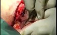 Pilonidalzystenoperation mit der modifizierten Karydakis-Methode