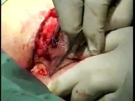 Pilonidalzystenoperation mit der modifizierten Karydakis-Methode