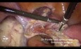 15 Min. Laparoskopische suprazervikale Hysterektomie