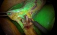 Laparoskopische Cholocystektomie mit intraoperativer ICG-Fluoreszenz-Cholangiographie