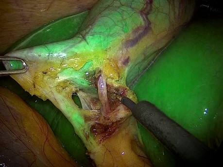 Laparoskopische Cholocystektomie mit intraoperativer ICG-Fluoreszenz-Cholangiographie