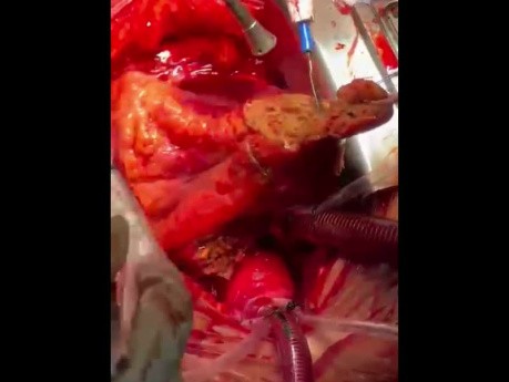 Ausgedehnte Resektion eines Herztumors unter kardio-pulmonalem Bypass