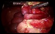 Laparoskopische Appendizektomie bei gangränösem Blinddarm