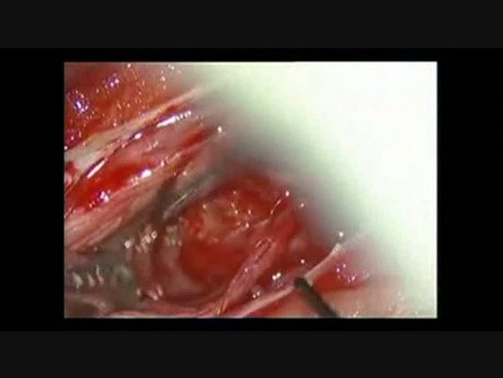 Spinales Meningeom – mikrochirurgische Entfernung