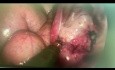 Tubale Durchgängigkeitsprüfung mit dem blue Test während einer VNOTES-Ovarialzystektomie.