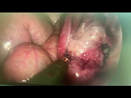 Tubale Durchgängigkeitsprüfung mit dem blue Test während einer VNOTES-Ovarialzystektomie.
