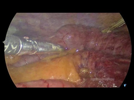 Minimal invasives Management der eingeklemmten transomentalen Hernie