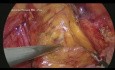 Laparoskopische Leistenhernienreparatur