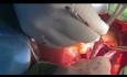 "Off Pumpf " Trikuspidalklappen Reparatur und Beseitigung der bakteriellen Endokarditis mit der Zeraatian-Technik