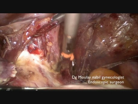 Totale laparoskopische Hysterektomie (Zustand nach Bauchschnitt)