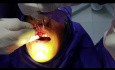 Verlängerung der klinischen Zahnkrone