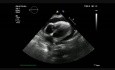 Herztamponade