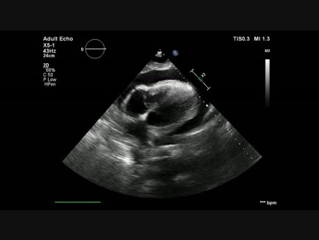 Herztamponade