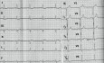 Hypertrophe Kardiomyopathie - EKG, Echokardiographie und Therapie