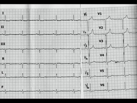 Hypertrophe Kardiomyopathie - EKG, Echokardiographie und Therapie