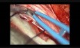 Rückenmarkstumor – Intradurales Neurofibrom – Mikrochirurgische Exzision
