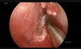 Endoskopische Septumplastik, Turbinoplastik und einseitige Therapie der Sinusitis