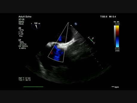 Persistierendes Foramen Ovale mit Links-Rechts-Shunt