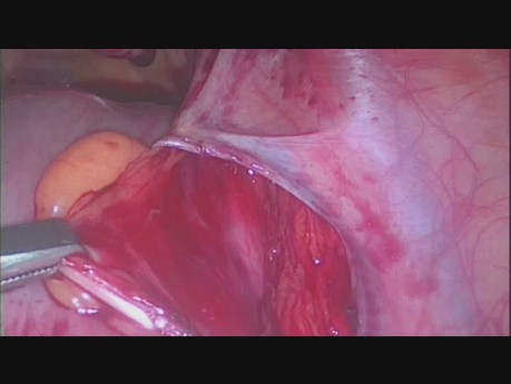 Visualisierung des rechten Ureters im Retroperitonealraum
