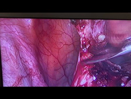 Laparoskopische Entfernung von Endometrioseherden