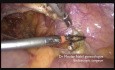 Totale laparoskopische Hysterektomie ( die adipöse Patientin)