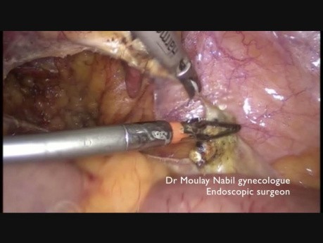 Totale laparoskopische Hysterektomie ( die adipöse Patientin)
