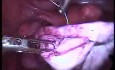 Operative Laparoskopie bei der großen Endometriosezyste