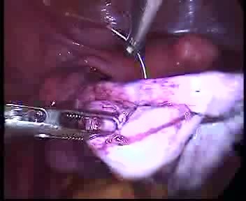 Operative Laparoskopie bei der großen Endometriosezyste