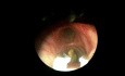 Ein 8-jähriger Patient mit einem Kürbiskern in seinem rechten primären Bronchus