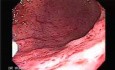 DIe akute Gastritis - Endoskopie