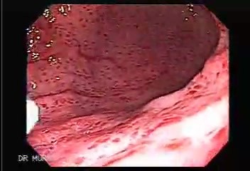 DIe akute Gastritis - Endoskopie