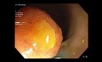 Endoskopische Mukosektomie (EMR) des LST-G-Sigmoidtumors