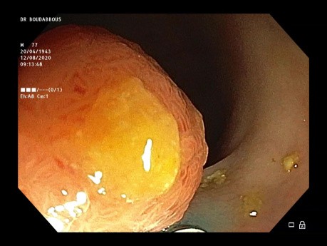 Endoskopische Mukosektomie (EMR) des LST-G-Sigmoidtumors
