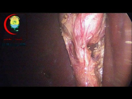 Dissektion des Ductus cysticus