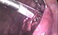 Operative Laparoskopie bei der Patientin mit ektopischer Schwangerschaft