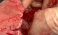 Verwendung eines Perikardpatches zur Rekonstruktion des linken Vorhofs am Back Table