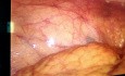 Peritonealtuberkulose in der Laparoskopie