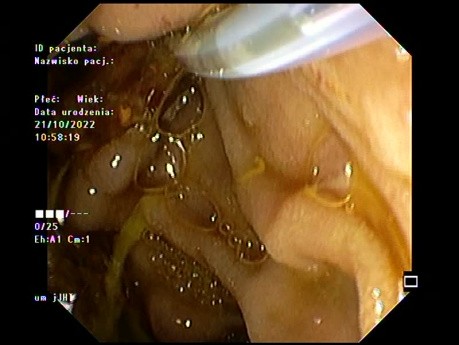 Eitrige Cholangitis
