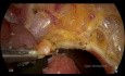 Transanale minimal-invasive Chirurgie bei malignen T1-Rektalpolypen